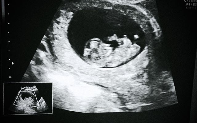 Bebé A Caminho – 11 Semanas